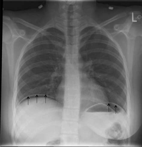 Chest Radiograph Demonstrating Free Intra Abdominal Air Open I