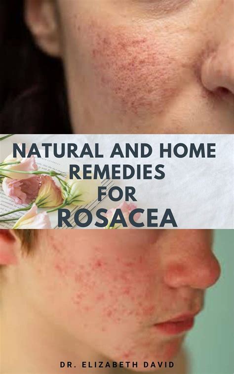 Natural And Home Remedies For Rosacea A Self Help Guide To Completely