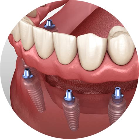 Full Mouth Dental Implants Abilene Tx Leedy Dental
