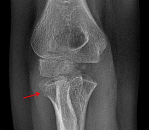 Displaced Radial Head Fracture