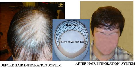 Non Surgical Hair Replacement Specialists Hair Loss Solutions Regrowth Service