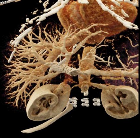 Pancreatic Cancer With Vascular Encasement With Cinematic Rendering