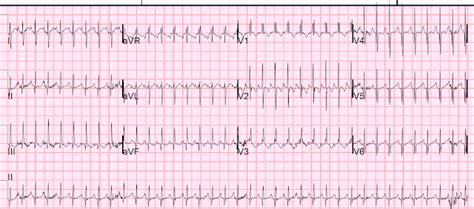 A Quick Guide To Pediatric Svt