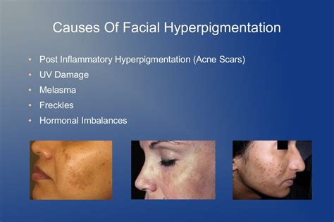 How To Treat Hyperpigmentation On The Face