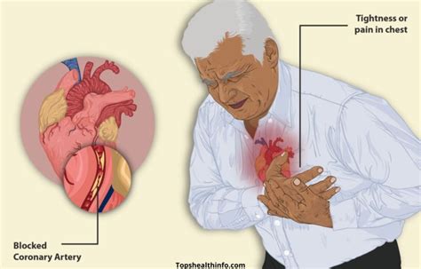 Angina Pectoris Symptoms Causes And Treatment At Germany