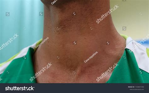 Huge Anterior Neck Swelling Left Thyroid Stock Photo 1103831336