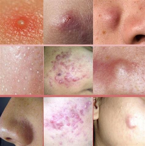 Types Of Acne Nodules