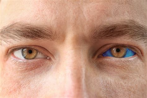 What Is Blue Sclera Possible Causes And What To Do