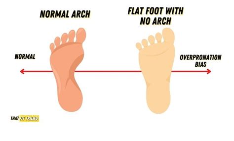 Dr Cs Journal Flat Feet And Overpronation Doctors Without Waiting