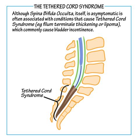 Definition Of Tethered Cord