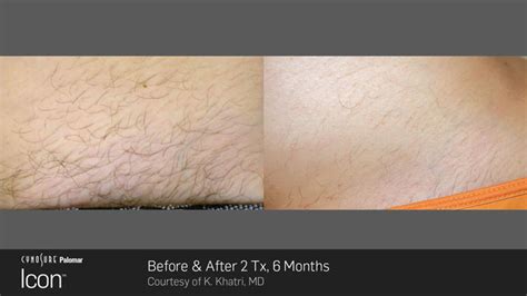 Laser Hair Removal Montrose Permanent Hair Reduction