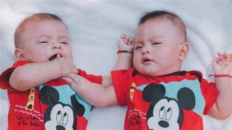 7 Fakta Anak Kembar Siam Dengan Otak Menyatu Sukses Dipisahkan Di