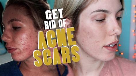what gets rid of acne scars fast
