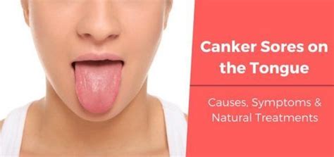 Effective Home Remedies To Treat Canker Sores On The Tongue Canker
