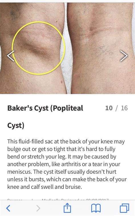 Idea By Kim Terrell On Know Your Body Ladies Bakers Cyst Cysts Tattoos