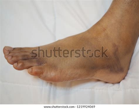 Foot Swelling Bruise Broken Foot Close Stock Photo Edit Now 1219924069