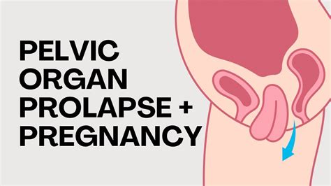 Managing Pelvic Organ Prolapse During Pregnancy Youtube