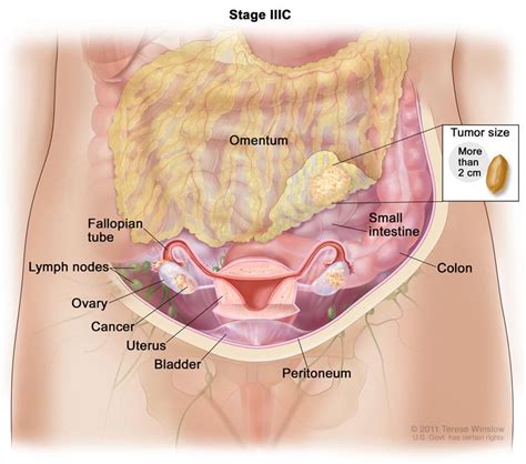 When cancer and capricorn get together, it's a relationship that's sweet, sincere, and enduring. Ovarian Germ Cell Tumors Treatment (PDQ®)—Patient Version ...