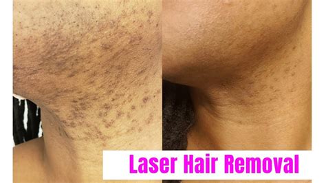 Vlog Laser Hair Removal For Black Women Romeo And Juliette Laser Hair