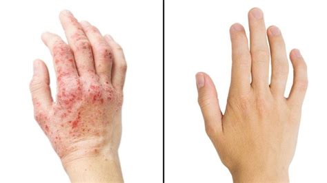 10 Things Itchy Skin Says About Your Health Itchy Skin Eczema