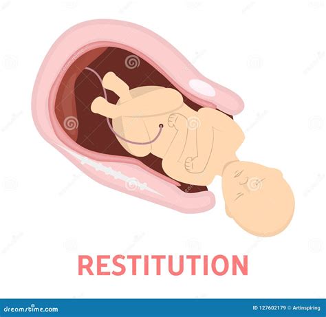 Restitution Stage Of Baby Birth In Vaginal Delivery Stock Vector