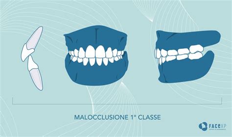 Malocclusione Che Cos E Come Riconoscerla