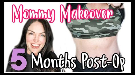 Mommy Makeover Recovery 5 Month Update Tummy Tuck Journeyscar Sarahs Wifestyle Youtube