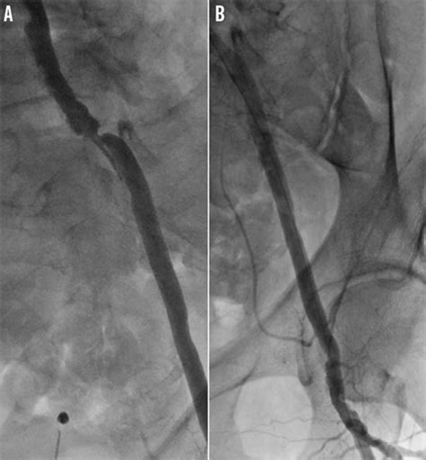 Guidewires For Lower Extremity Artery Angioplasty A Review