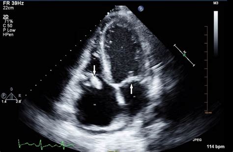 Transthoracic Echocardiogram Tte Showing Tricuspid And Mitral