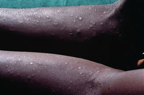 Syphilis Rash In An Aids Patient Photograph By Dr Ma Ansaryscience