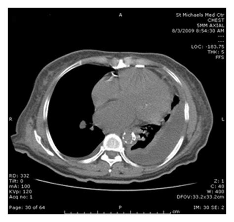 Ct Scan Of The Chest Showing A Large Left Pleural Effusion With
