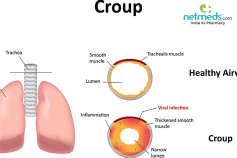 Croup Causes Symptoms And Treatment