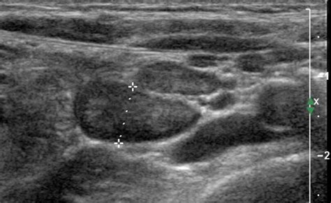 Enlarged Lymph Nodes Ultrasound