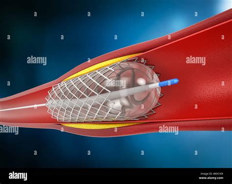 3d Rendering Balloon Angioplasty Procedure With Stent In Vein Stock