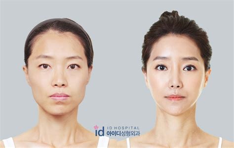 Id Hospital Korea Orthognathic Surgery In Korea Two Jaw Surgery