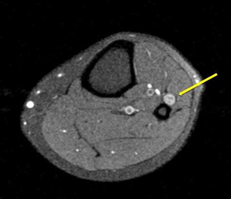 Superficial Peroneal Nerve Schwannoma Presenting As Lumbar Radicular