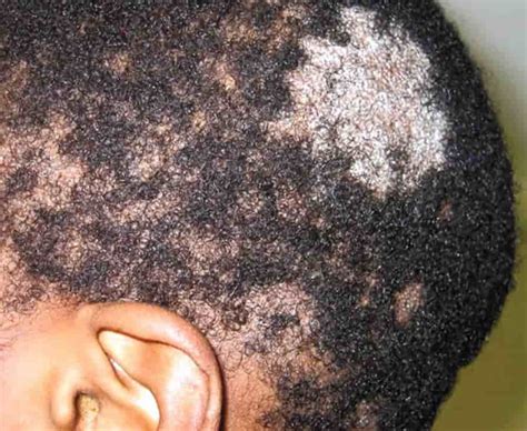 Ringworm Hair Loss Signs Causes And Treatments Longevita