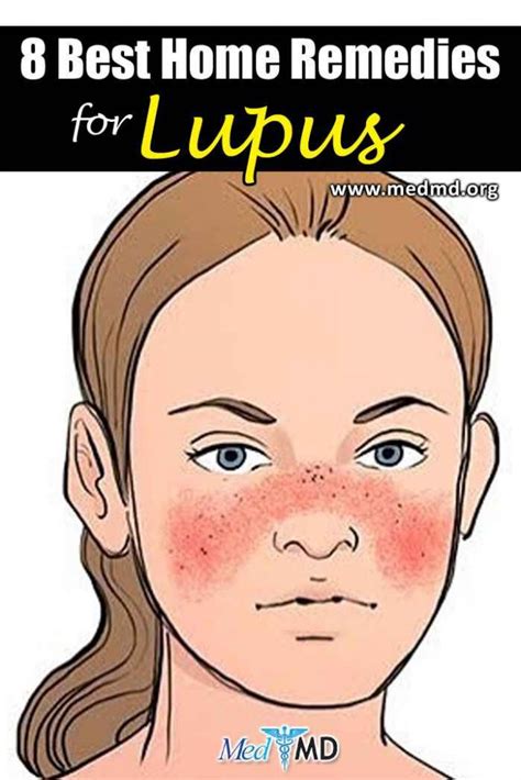 8 Best Home Remedies For Lupus