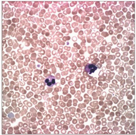 Oct 02, 2019 · hypoventilation syndrome, congestive heart failure, obstructive sleep apnea, poor blood flow to the kidneys, and; Acquired Erythrocytosis | Basicmedical Key