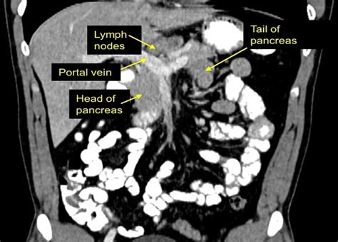 Cases Of The Week “abdominal Lymph Nodes Peripancreatic And