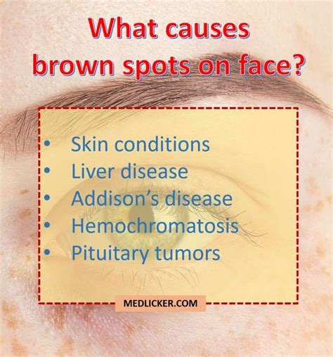 Overview Of Causes Of Brown Spots On Face Acnecausesonface Brown