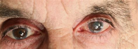 Eye Cataract Causes Get Images