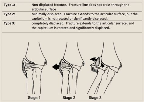 Paediatric Lateral Condyle Fractures Of The Distal Humerus