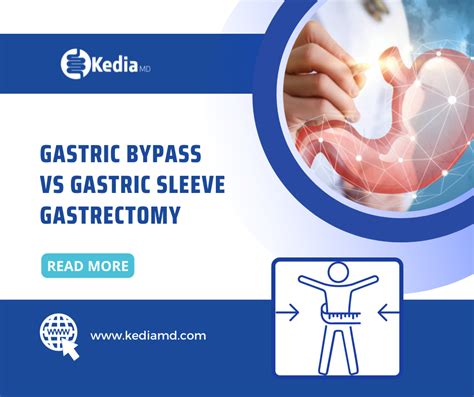 Gastric Bypass Vs Gastric Sleeve Gastrectomy