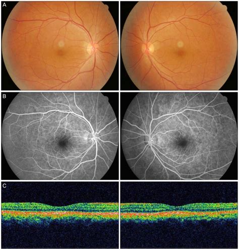 A Fundus Photographs Of The Right Eye Left And Left Eye Right