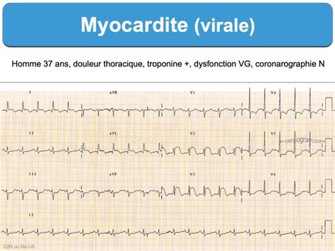 Myocardite : e-cardiogram