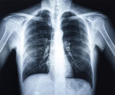 Rib cage rises due to the pressure of the chest. Difference Between Pulled Muscles and Bruised Ribs | Bruised ribs, Cancer, Cystic fibrosis