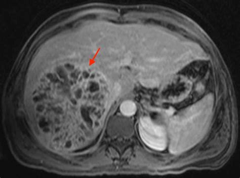 Cureus Complicated Isolated Liver Abscess Caused By Viridans Group
