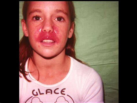 Facial Rash Red Skin Syndrome