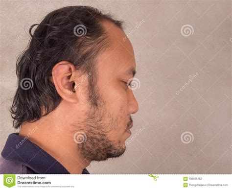 Bald Head Man Stock Image Image Of Closeup Problem 106451753